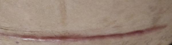 Ide o hypertrofickú jazvu?