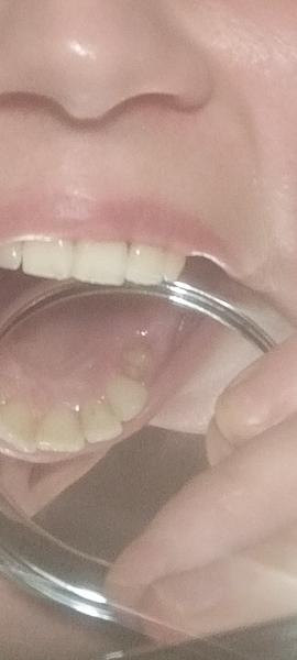 Odhalená kosť po extrakcii zuba spôsobuje bolesť