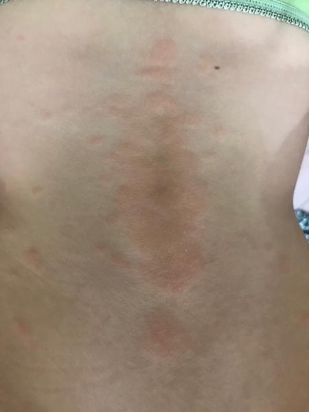 5 ročná dcéra má vyrážky. Sú potrebné testy na alergiu?