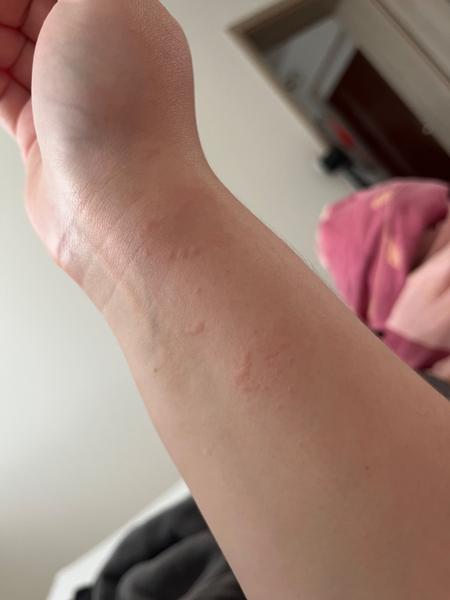 Možné príčiny svrbenia po oliznutí kocúrom?