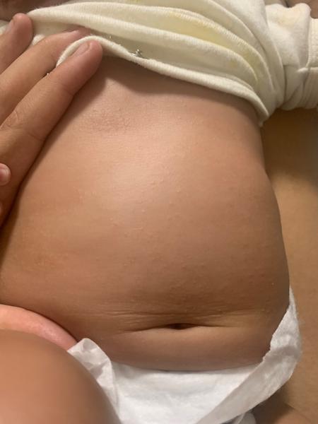 Dcéra s ABKM má vyrážky. Čo to môže byť?