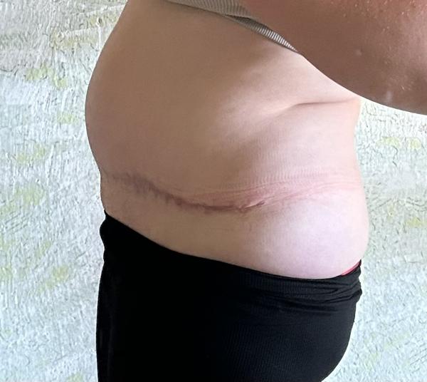 Som vhodný kandidát na liposukciu?