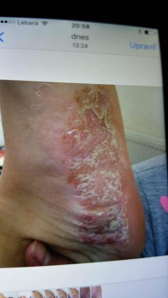 Je to psoriáza?