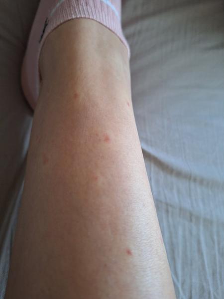 Je to od blchy alebo ploštice?