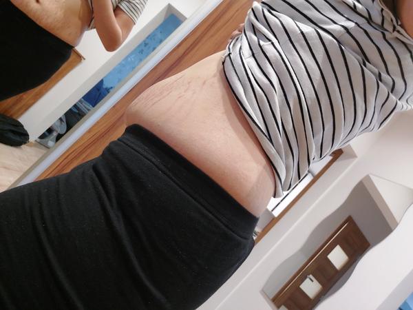 Dá sa odstrániť moje brucho po pôrode?