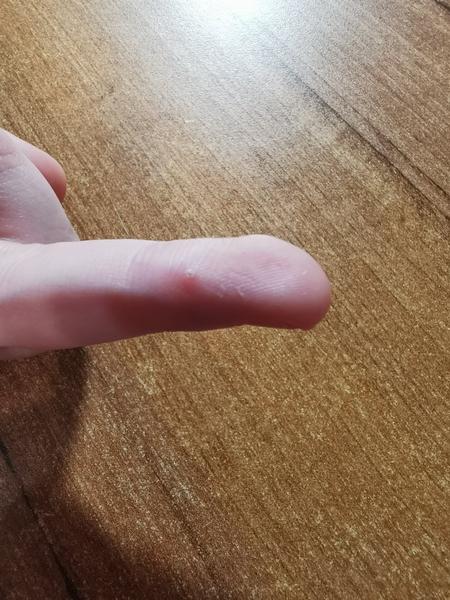 Je to kurie oko alebo bradavica na prste?