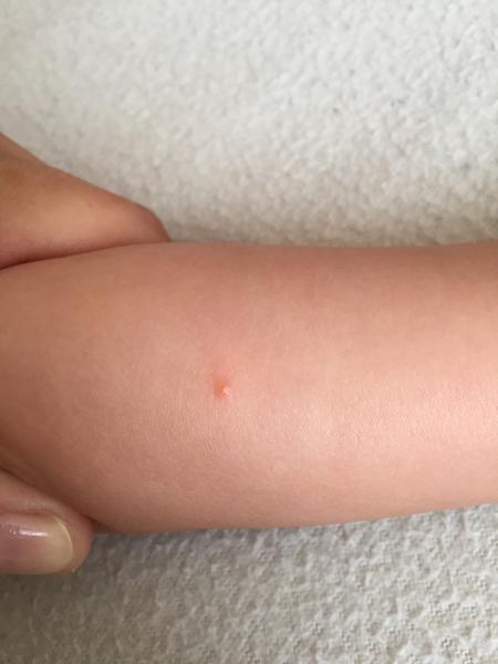 Čo sú toto za vyrážky u dvojročnej dcérky?