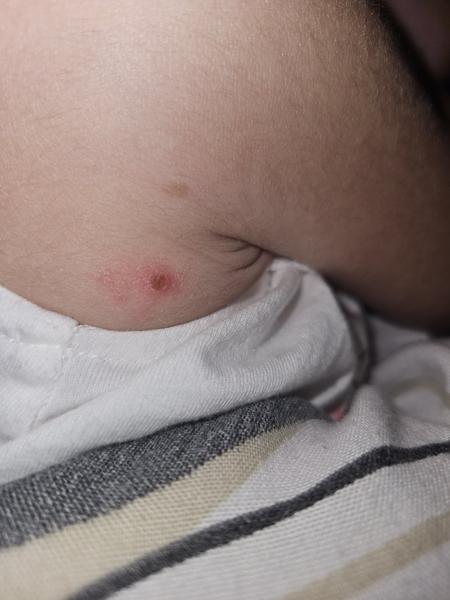 Čo znamená vyrážka pri pazuške dcérky?