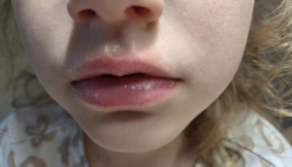 Čo na suché pery u dieťaťa?