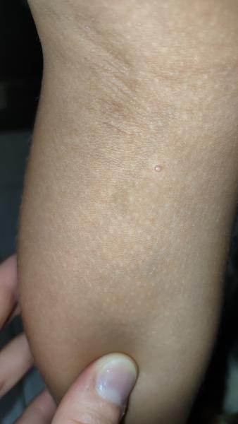 Zvláštne vyrážky na nohe