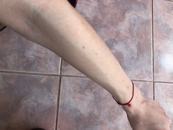 Čo mi pomôže na žily?