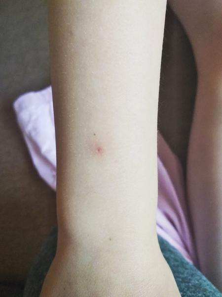 Aké červené bodky má na ruke moja 6 ročná dcéra?