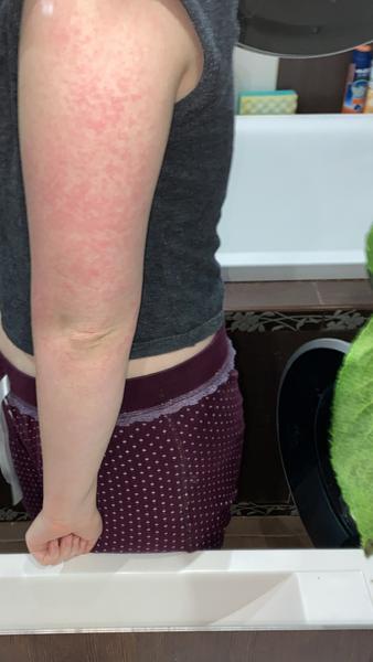 Aké červené fľaky to mám na rukách?