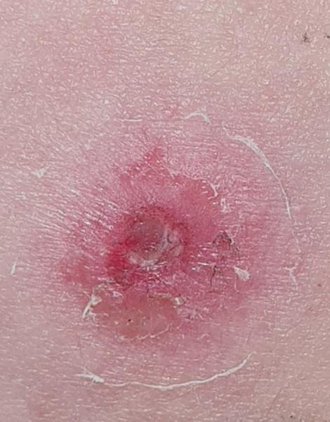 Z čoho môžem mať takúto vyrážku?