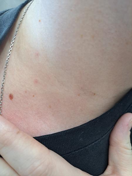 Na krku sa mi vytvorila gulička. Mám ísť za lekárom?