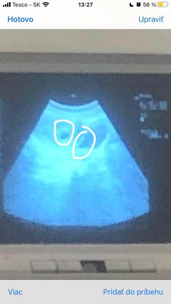 Ultrazvuk v 6. týždni - dvojičky