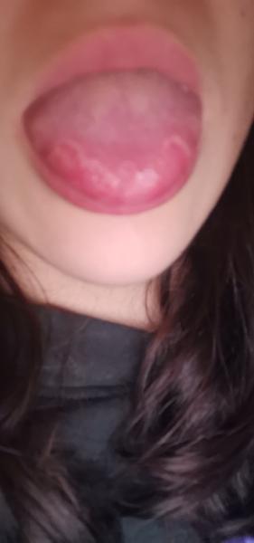 Z čoho sa mi tvoria takéto fľaky na jazyku a ako sa ich zbaviť?