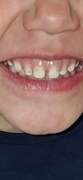 Čierne škvrny na detských zuboch. Ako ich odstrániť?