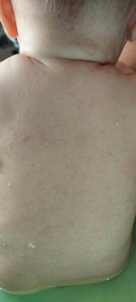 Čo mohlo spôsobiť vyrážky u 8-mesačného dieťaťa?