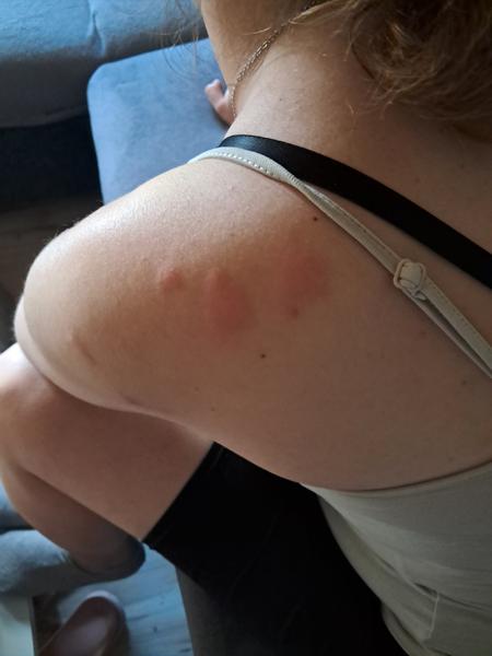 Červené svrbiace fľaky na tele