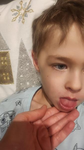 Čo spôsobuje opuch medzi uchom a okom?