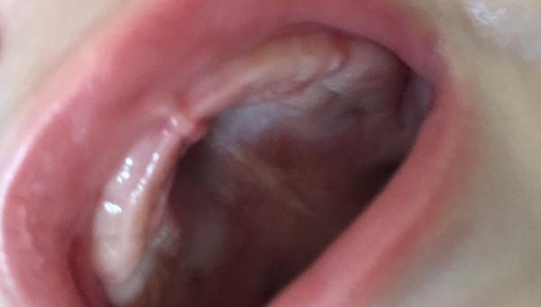 Môže sa jej prerezávať zub?