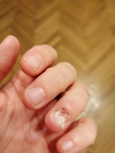 Ako prestať s obhrýzaním nechtov? Poraďte!