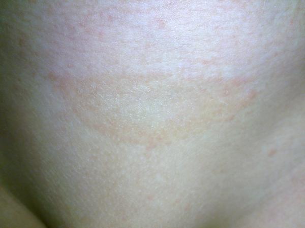 Čo znamenajú tieto suché fľaky?