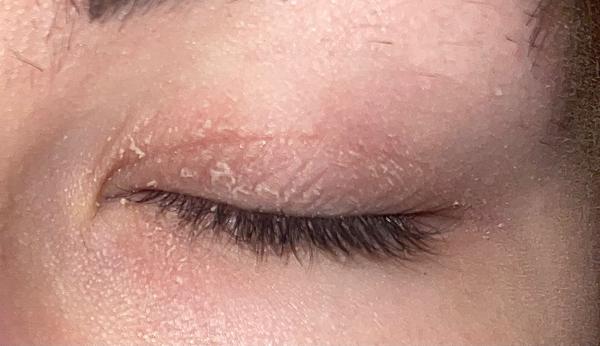 Suché šupinky a opuch na očnom viečku?