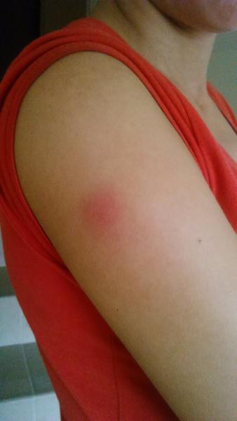 Červená vyrážka na ramene