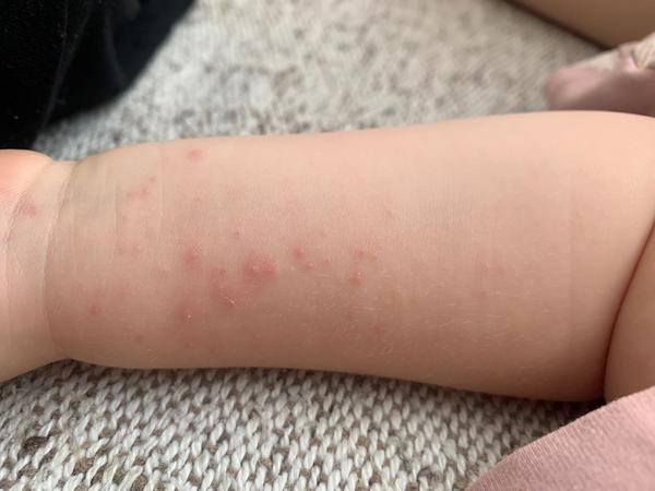 Čo za vyrážky má moja dcérka na rukách?