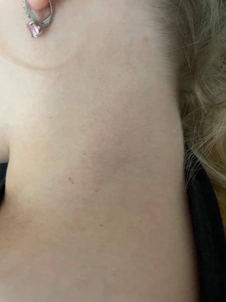 Červené bodky u detí