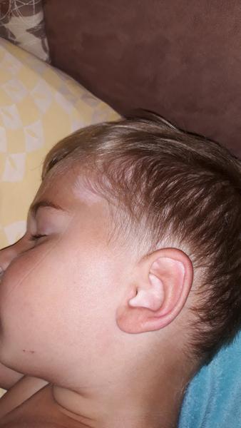 Ako liečiť znamienka, v ktorých chýba pigment?