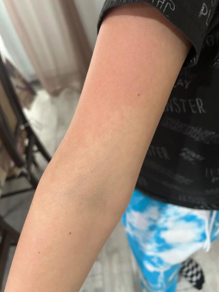 Je to piata choroba alebo osýpky?