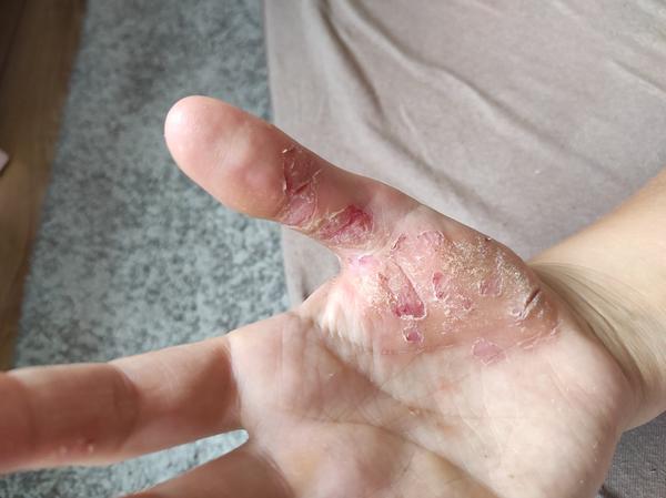 Extrémne suché a popraskané ruky