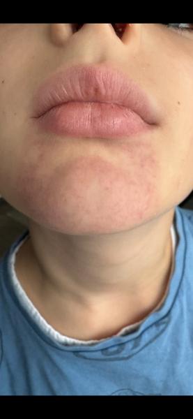 Čo môže spôsobiť fľak na brade dieťaťa?