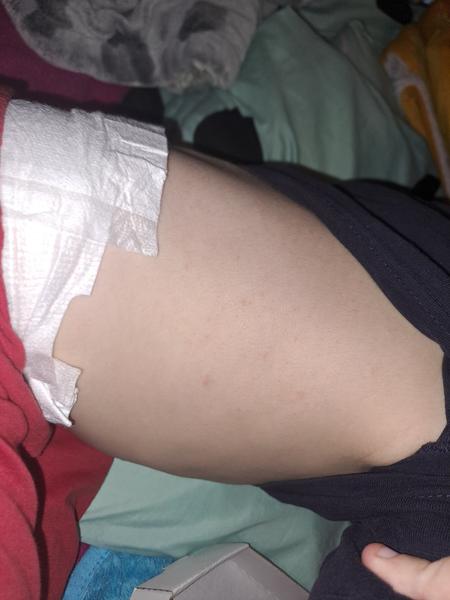 Syn má opakujúce sa vyrážky – čo môže byť príčinou?