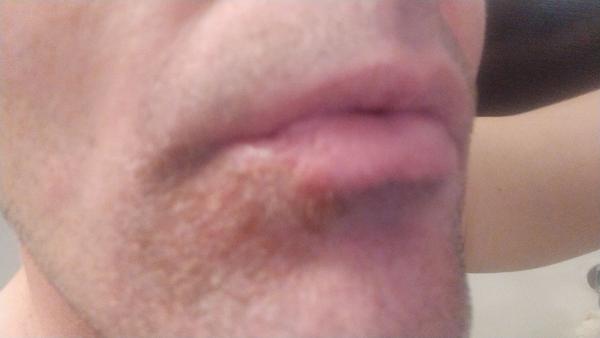 Kožný útvar na tvári