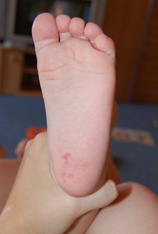 10 mesačná dcérka má na pätách ako keby podliatiny