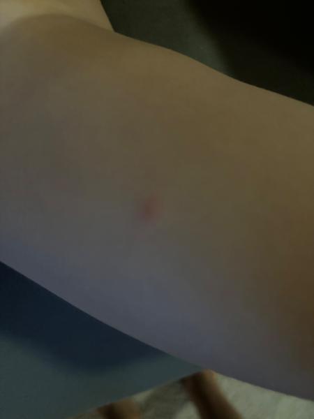 Môžu to byť kiahne?