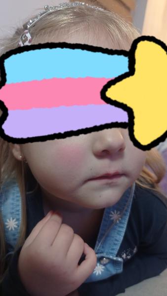 Prečo má štvorročná dcéra teplý červený fľak na líci?