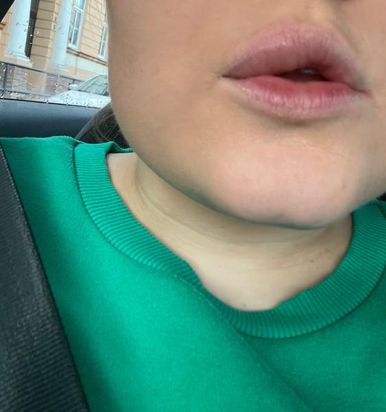 Opuch jednej pery: Aké sú príčiny?