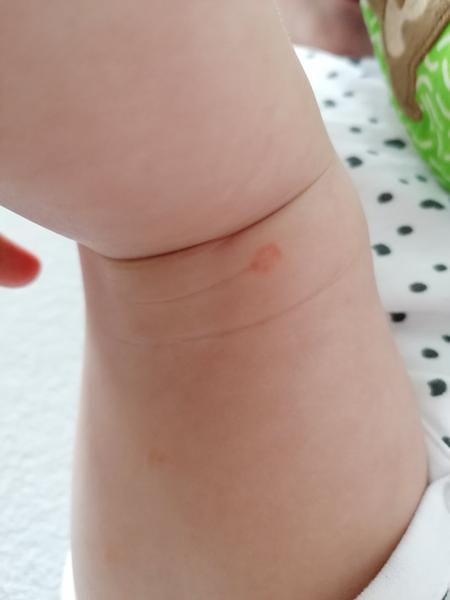 Aké vyrážky sa objavili u mojej dcérky?