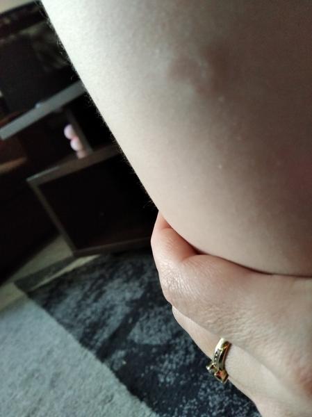 Čo znamenajú podkožné kolieska na nohách trojročnej dcéry?