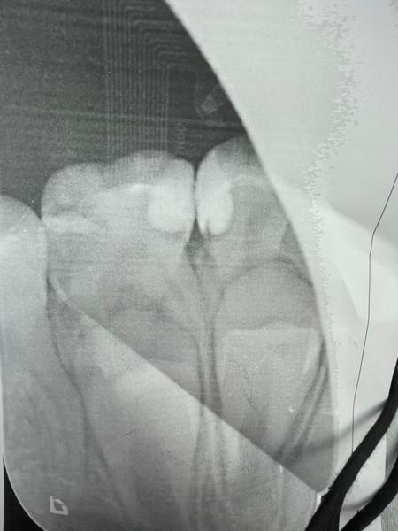 Vysvetlenie RTG detských zúbkov. Je tam kaz?