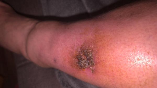 Ako liečiť rybami napadnutú ranu?