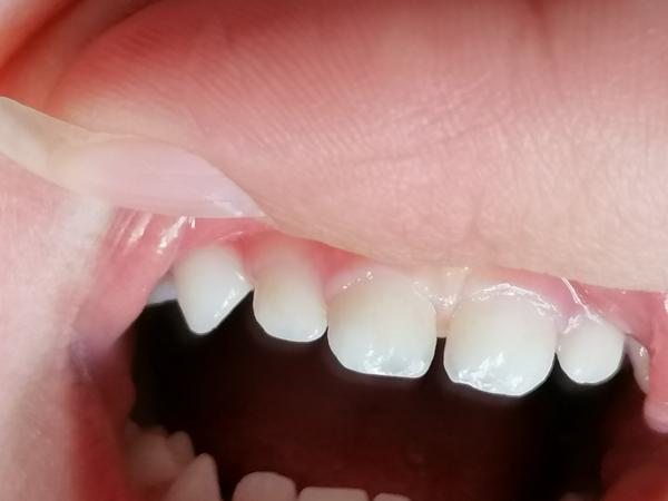 Má moja 19 mesačná dcérka kaz?