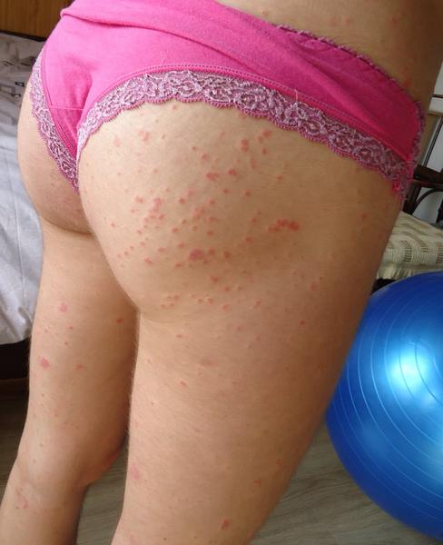 Ako som si vyliečila psoriázu