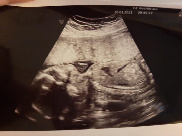 Ultrazvuková snímka v 20. týždni - tvár