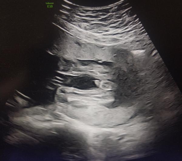 Je určenie pohlavia na ultrazvuku spoľahlivé?